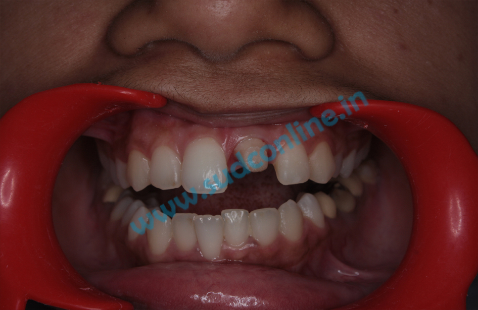 Dental bridges