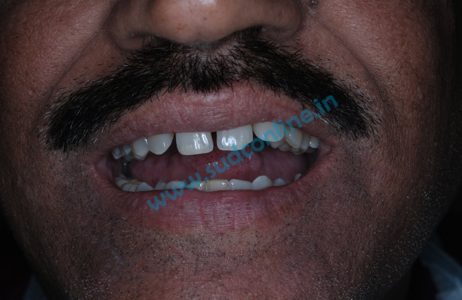 Dental bridges