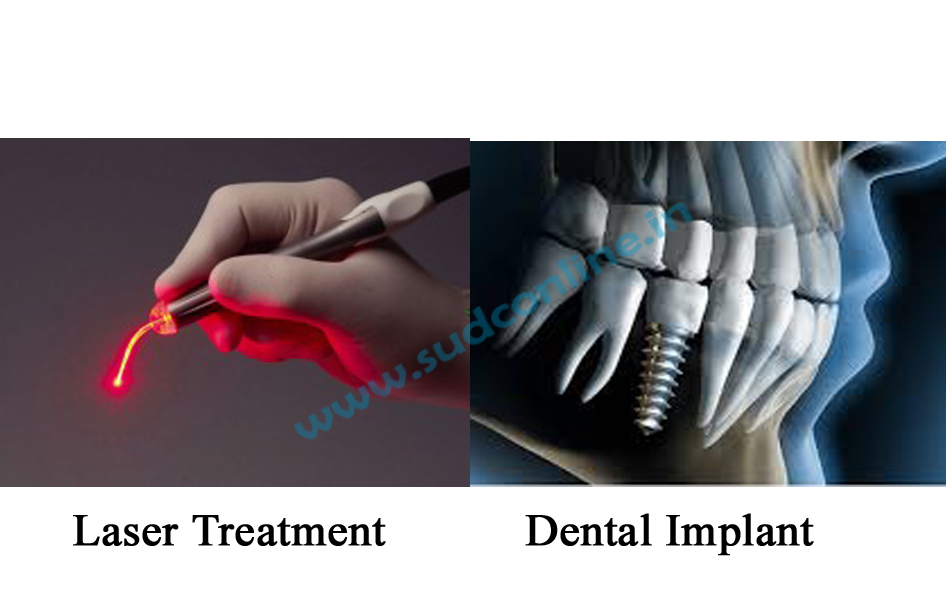 Dental bridges